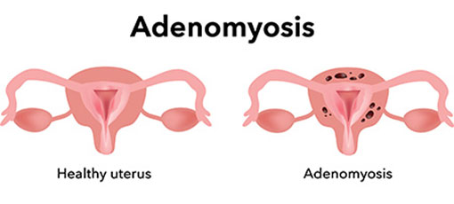 Adenomyosis