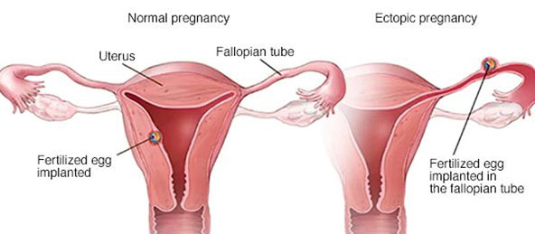 Ectopic Pregnancy