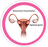 IUI Intrauterine Insemination