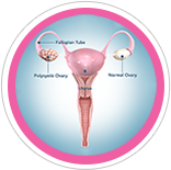 Polycystic ovary syndrome