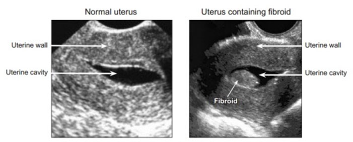 Sonohysterogram - HSO