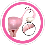 Tubal Reversal
