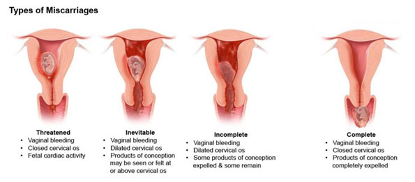 Types Of Miscarriages