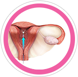 Hip Joint Replacement