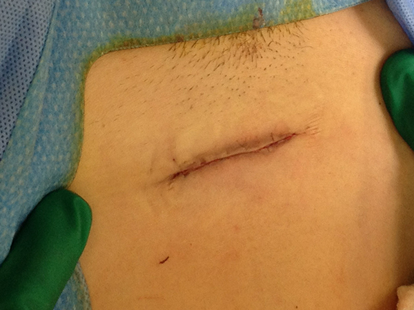 Tubal Reversal Dallas InVitro Fertilization (IVF